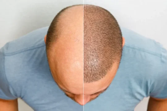 10 Reasons to Get a Hair Transplant in Turkey
