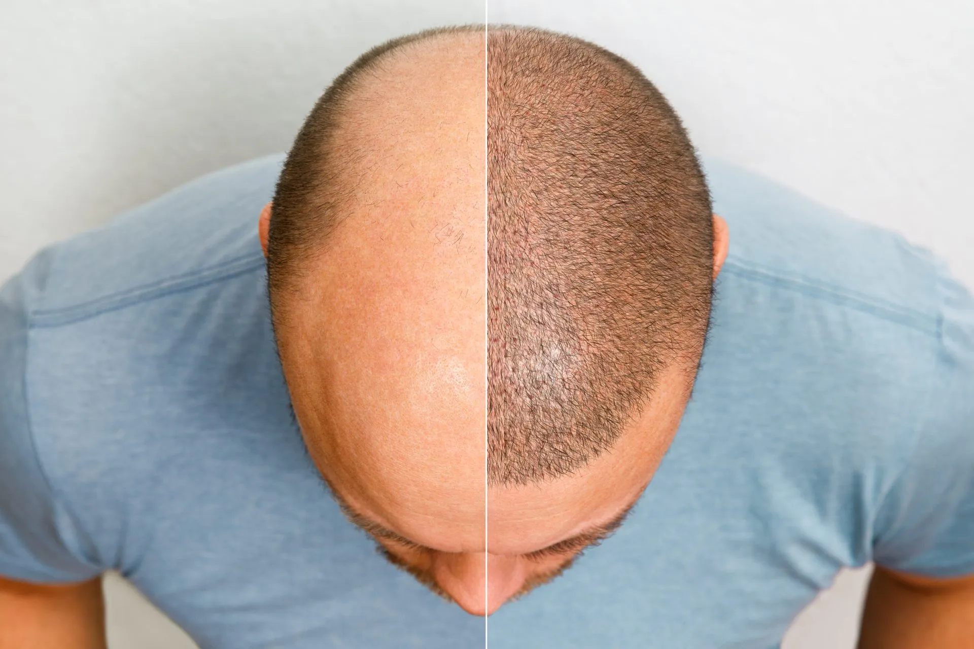 10 Reasons to Get a Hair Transplant in Turkey