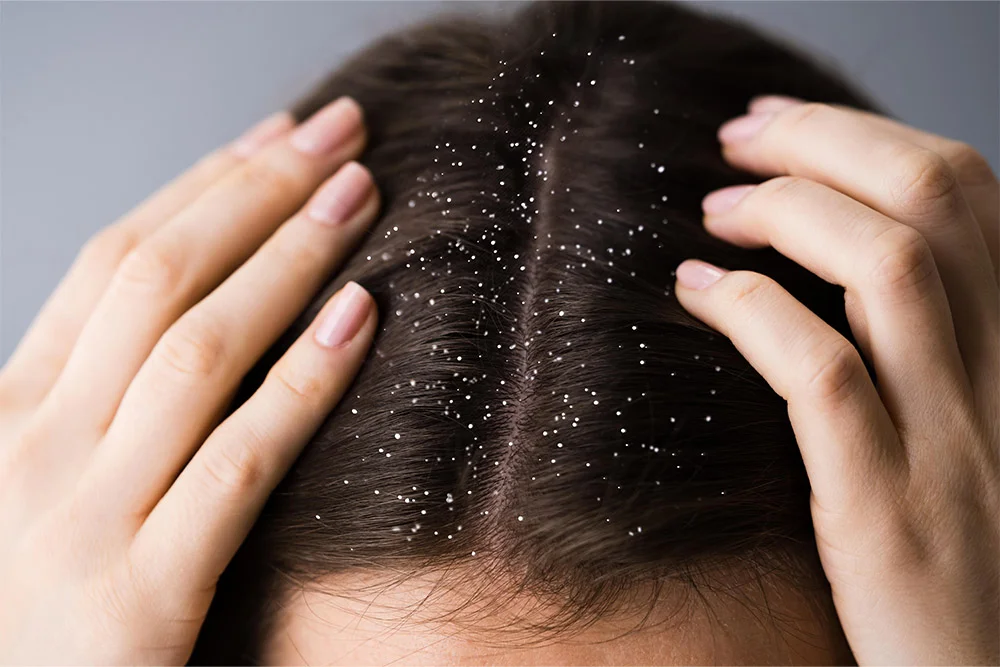 What is Dandruff? How to Get Rid of Dandruff?