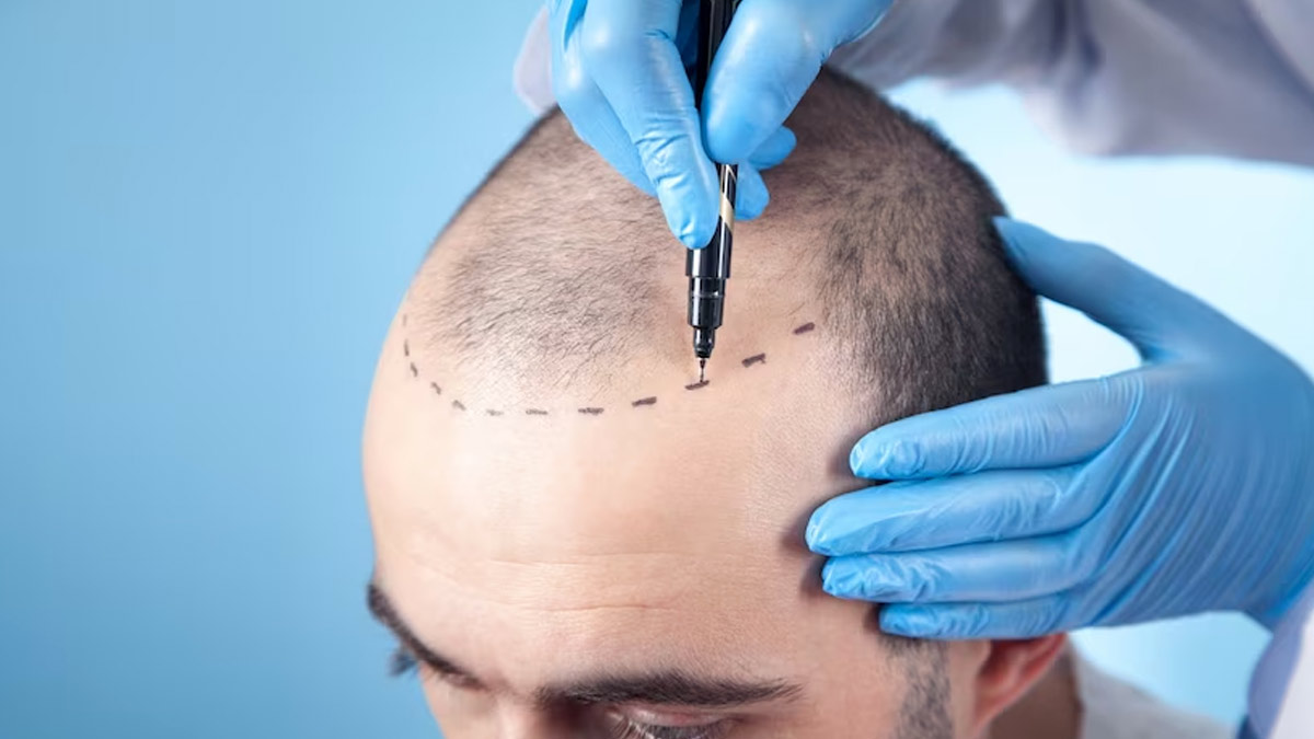 FUE Hair Transplant