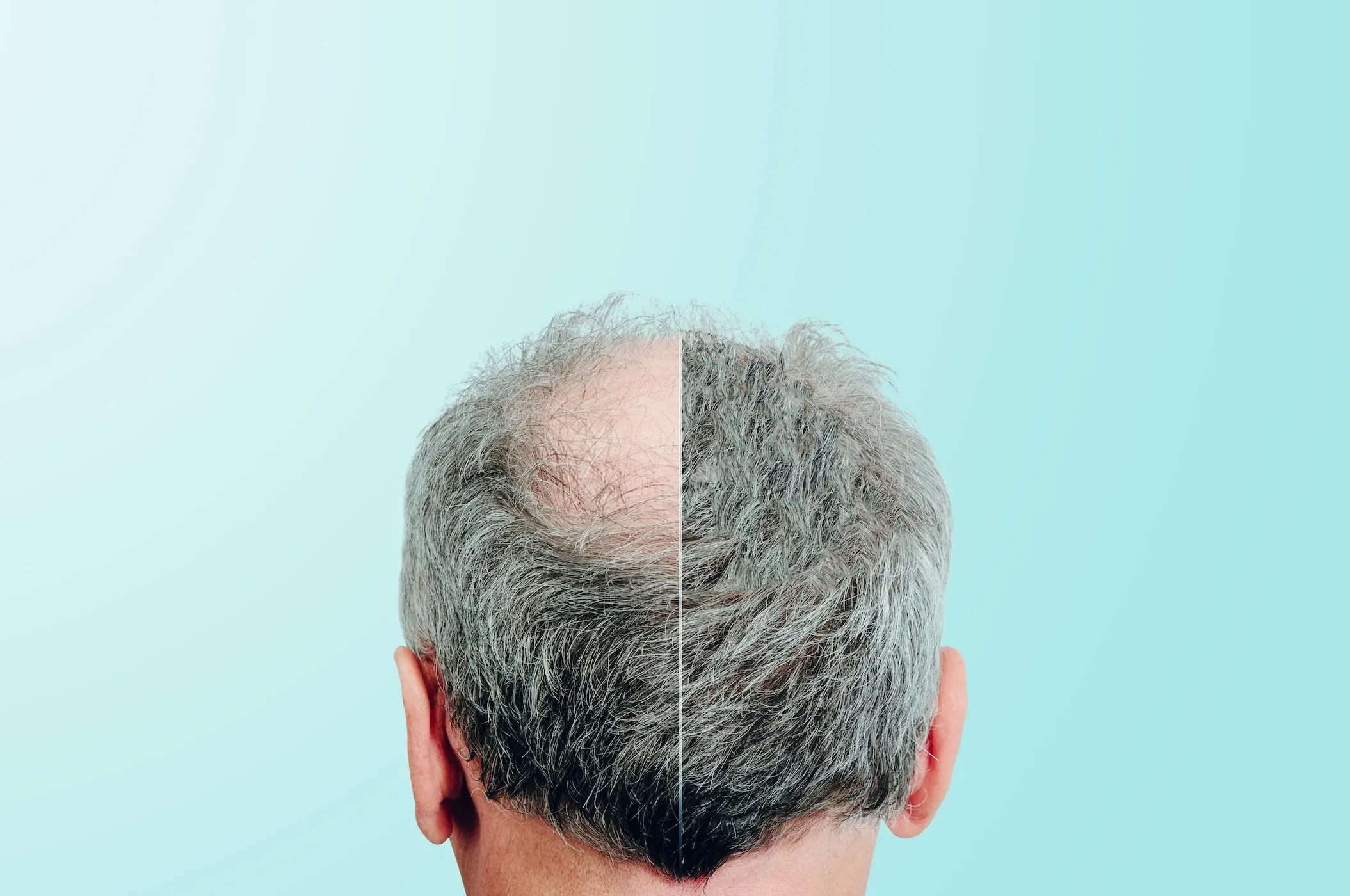 FUE Hair Transplant