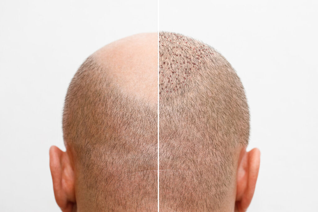 Cost of Hair Transplant in Turkey