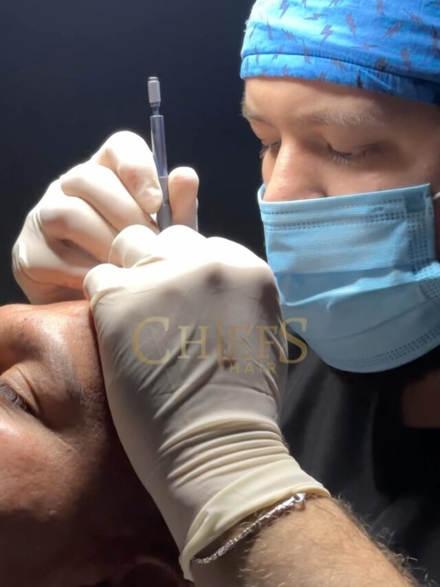 Hair Transplant in Turkey