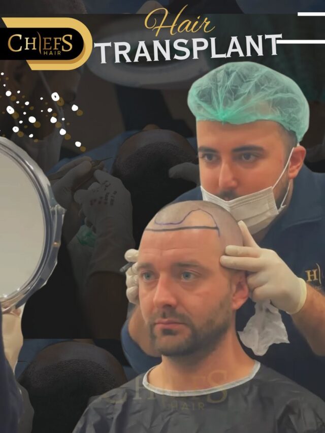 HairChiefs Hair Transplant in Turkey