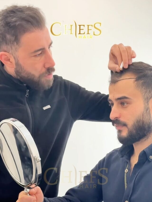 Hair Chiefs Hair Transplant in Turkey