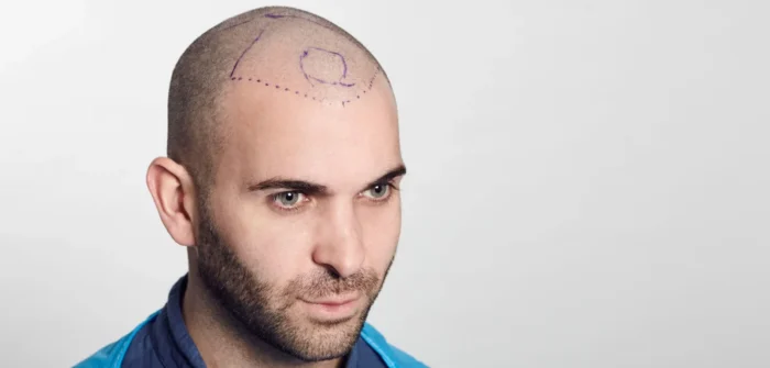FUE Hair Transplant Method and Other Methods