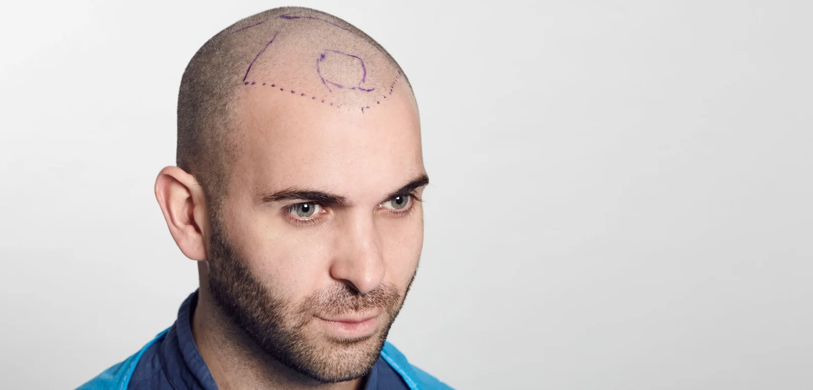 FUE Hair Transplant Method and Other Methods