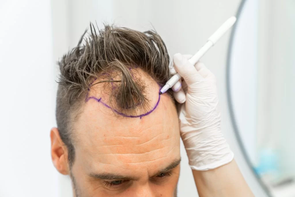 hair transplant methods-applied in turkey