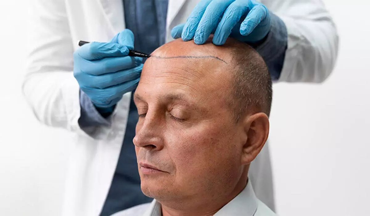 How Long Does a FUE Hair Transplant lLast?