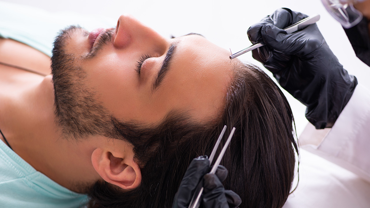 how permanent is hair transplant