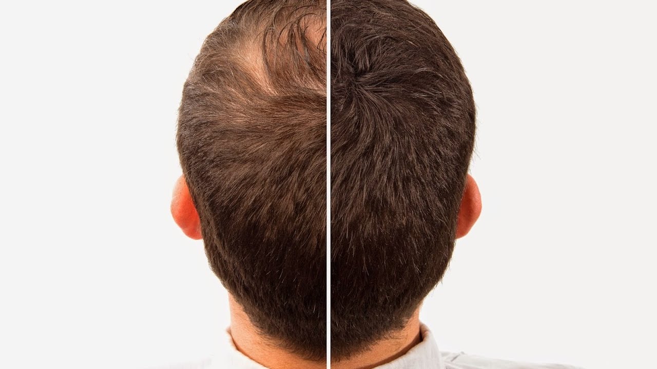 Turkey Importance in Hair Transplantation