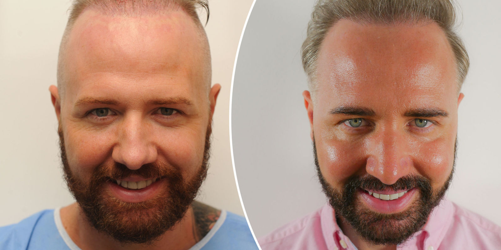 Turkey Importance in Hair Transplantation