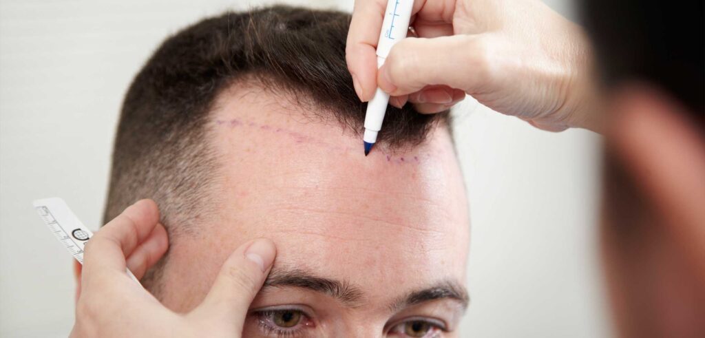 What is the Most Preferred Hair Transplant Method?