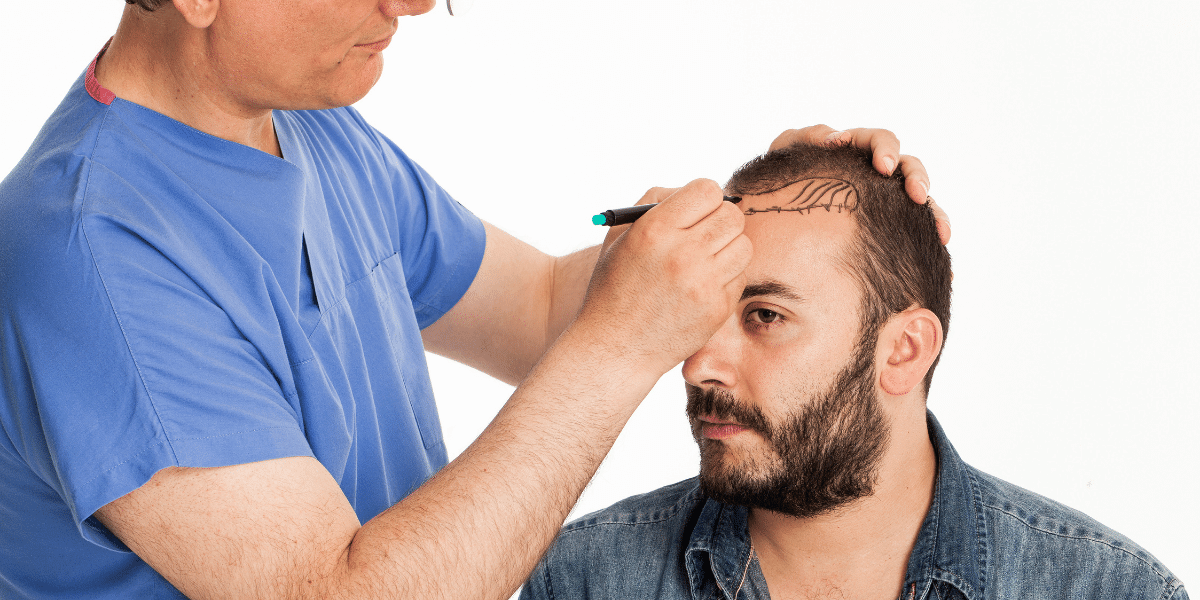 What is the Most Preferred Hair Transplant Method?